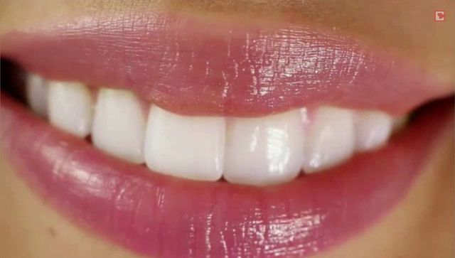 Zähne aufhellen: 3 Tipps für weißere Zähne